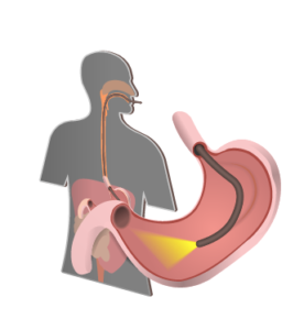 Diagnosing Eosinophilic Esophagitis