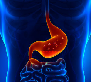 Diagnosing Eosinophilic Esophagitis