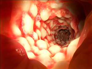Crohn's Disease in Pediatric Patients